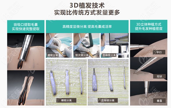 苏州青云3D植发技术介绍