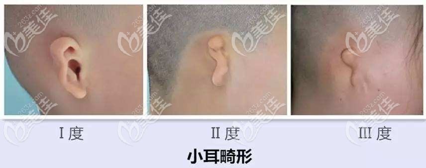 武汉可以矫正的小耳畸形类型236z.com