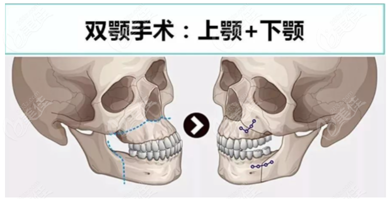 上海时光医院何晋龙做正颌手术怎么样？