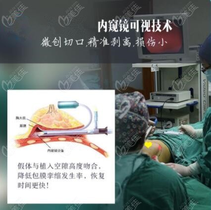 沈阳杏林做丰胸优势