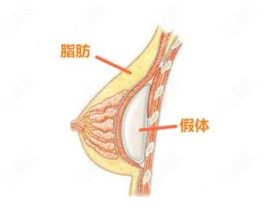 沈阳杏林做复合隆胸好的医生推荐m.236z.com