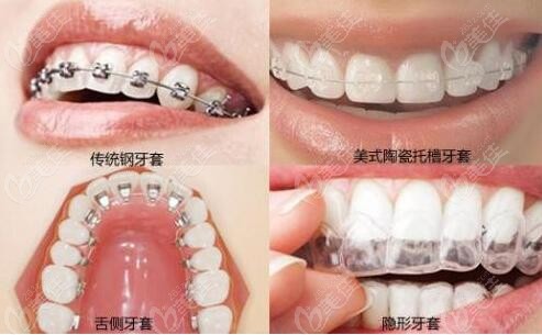 北京平谷牙科医院牙齿矫正价格表