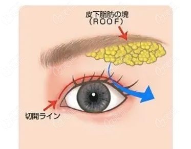 眉毛合并双眼皮手术提眉法