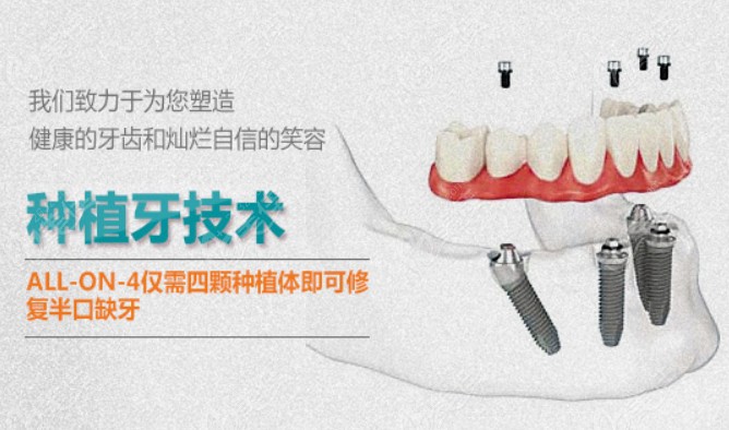 长沙半/全口种植牙多少钱