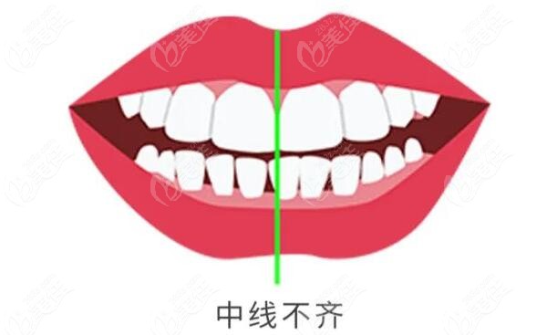 牙齿中线不齐也会导致偏颌
