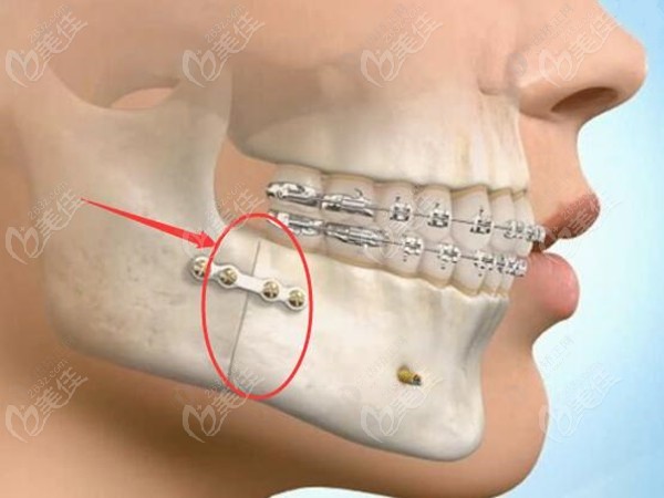 骨性偏颌需做正颌手术