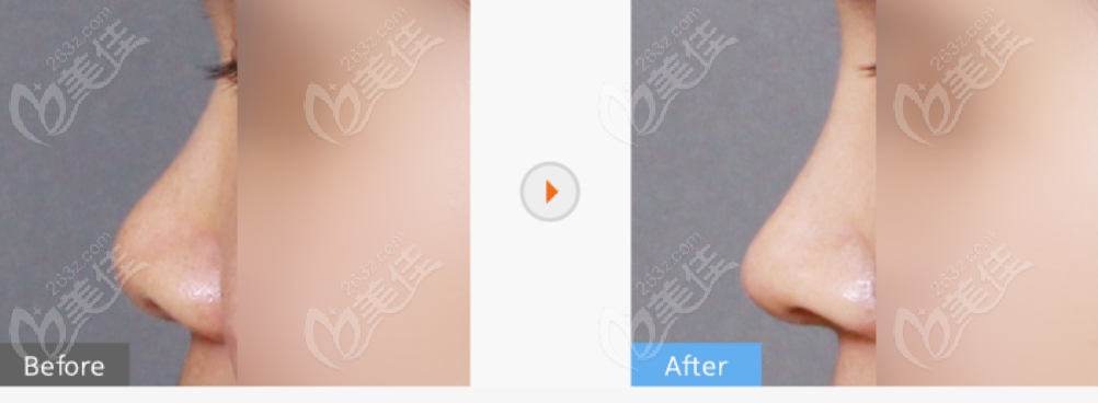 韩国格瑞丝噢爱美医院短鼻延长术图片