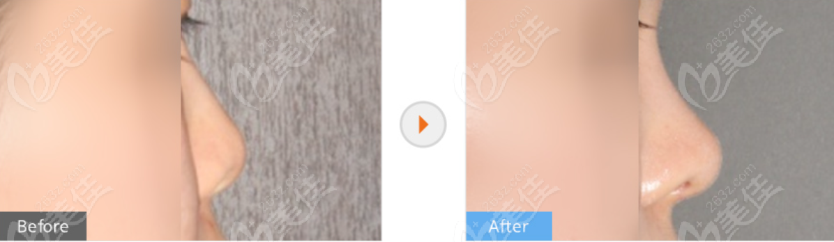 韩国格瑞丝噢爱美医院鼻尖挛缩修复图片和真人实例