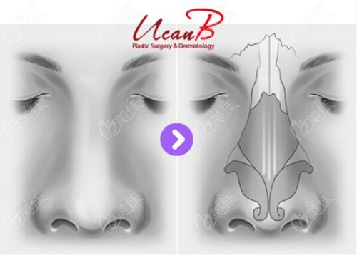 韩国Ucan整形鼻子技术图
