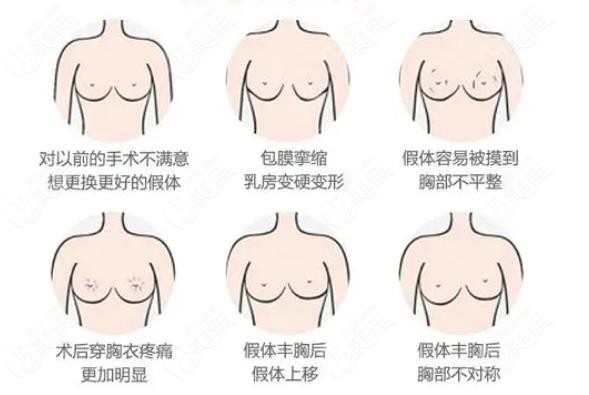 郑州隆胸修复医院排名前十