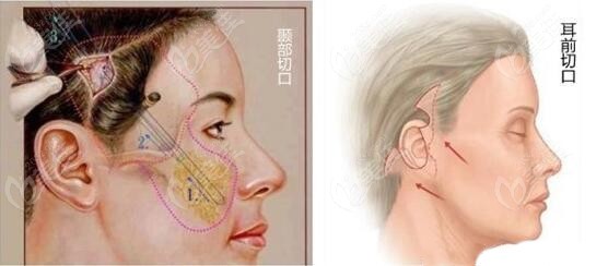小切口拉皮手术切口示意图www.236z.com