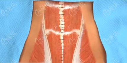 腹部拉皮手术图片示意图参考（m.236z.com）