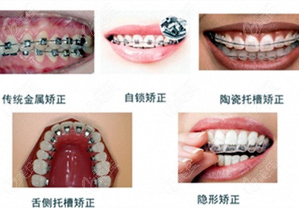 牙齿矫正器的类型