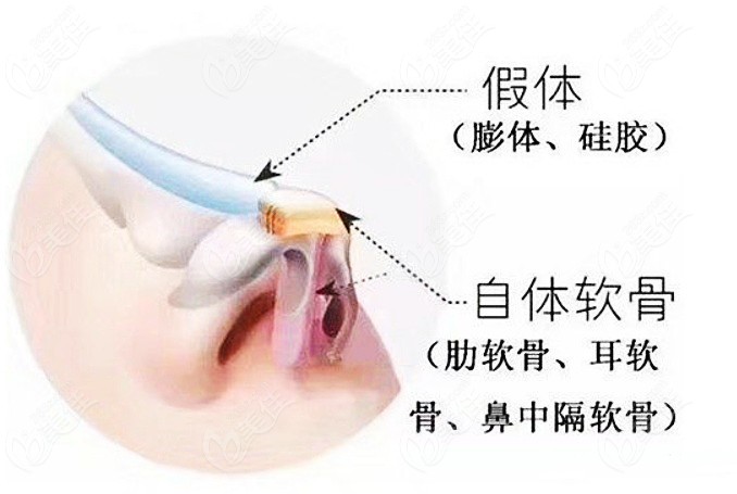 赤峰做假体隆鼻和自体软骨隆鼻的原理图www.236z.com