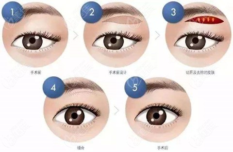 哈尔滨刘长松切眉技术图