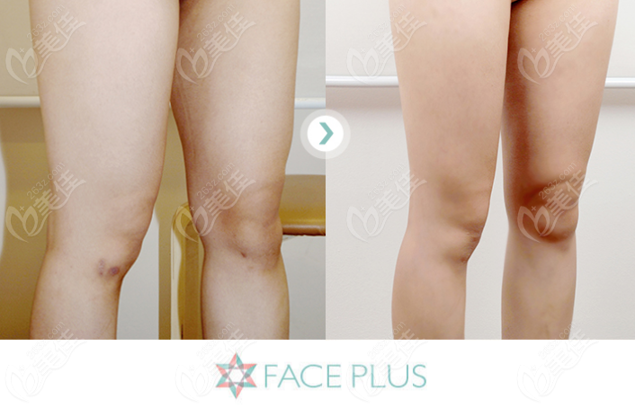 韩国faceplus整形医院大腿+小腿吸脂6个月对比图