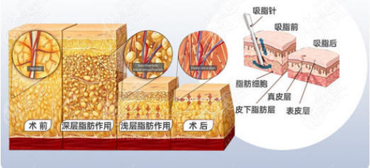 吸脂手术原理示意图