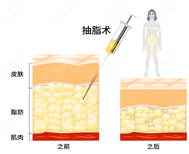 土麦森吸脂恢复时间快吗