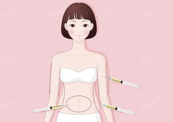 土麦森吸脂不用穿塑身衣吗？