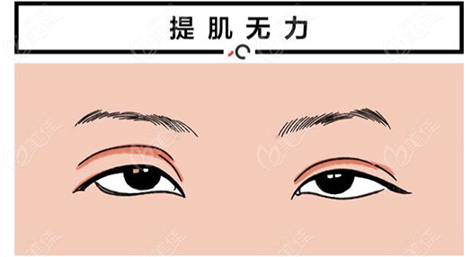 兰州郭晓磊修复双眼皮例子