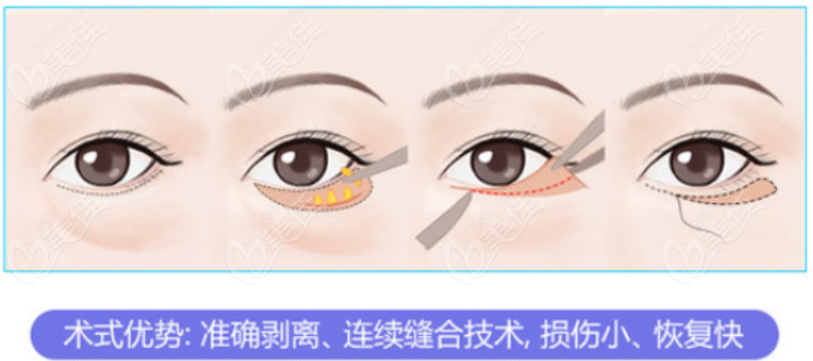 成都高新区祛眼袋比较好的医院排名