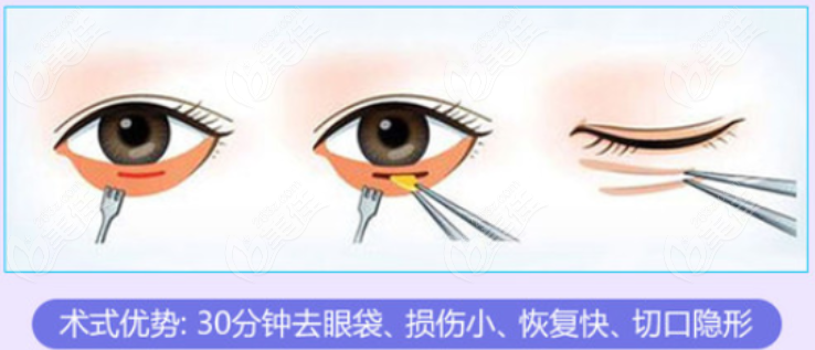 成都青羊区做眼袋手术好的医院有哪些