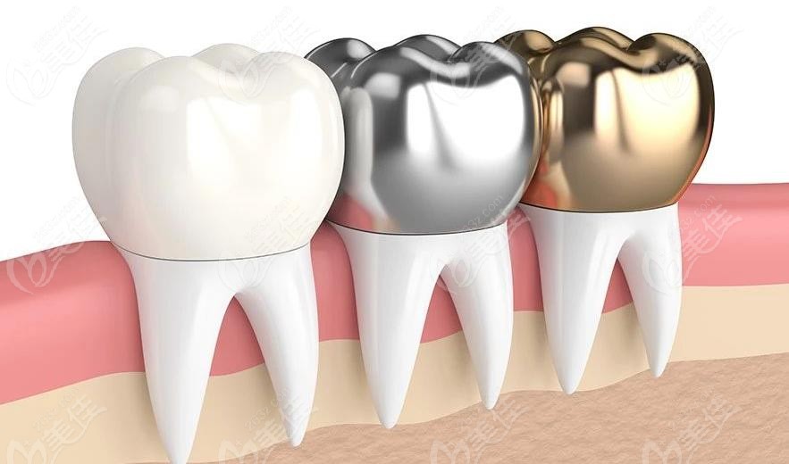 不同材质牙冠示意图
