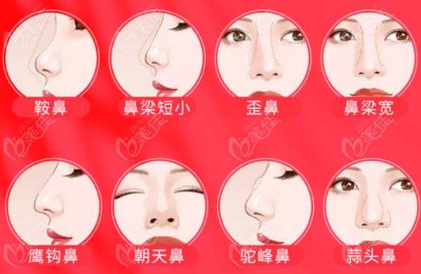 成都李萍鼻子做的怎么样