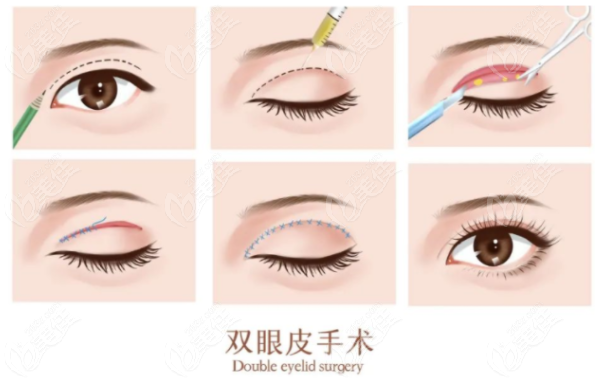 成都李萍医生双眼皮做的怎么样