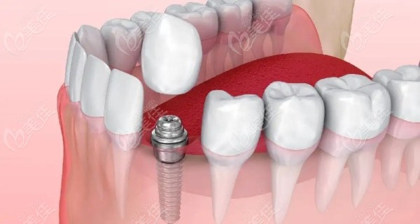 镶牙更好的修复方式是种植牙
