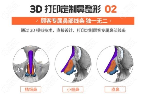 韩国歌柔飞整形医院主打3D打印鼻技术