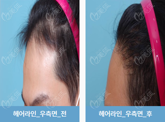 韩国环球医院毛发移植中心植发实例分享