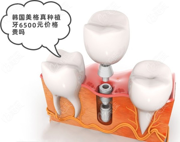 韩国美格真种植牙6500元价格贵吗