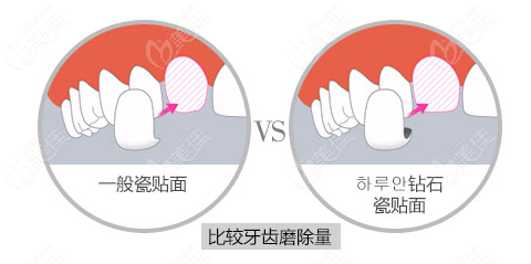 韓國id牙齒貼面