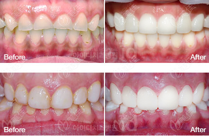 id做的牙齒貼片