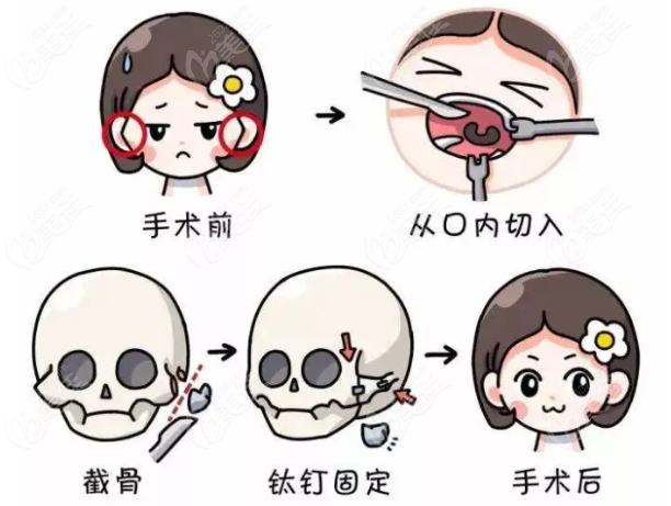 成都改脸型手术哪里比较好