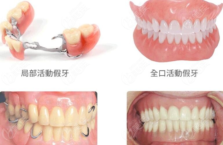 大连德馨口腔可修复各种缺牙状况