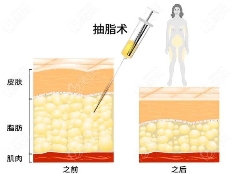 北京艺美王东吸脂技术优势