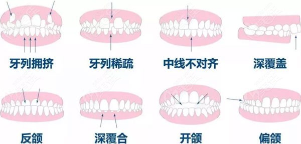 牙齿不齐情况区分