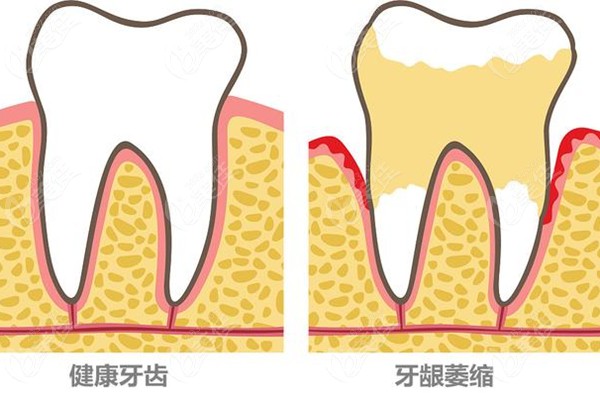 牙龈萎缩和健康牙齿对比图236z.com