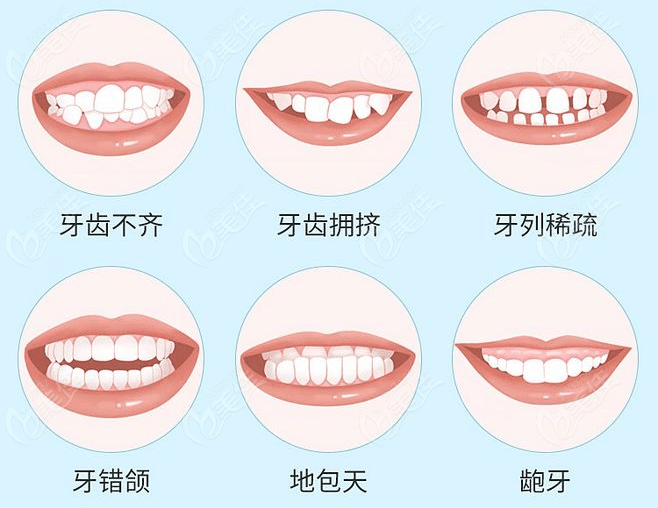袁虎医生可做的畸形牙齿类型236z.com