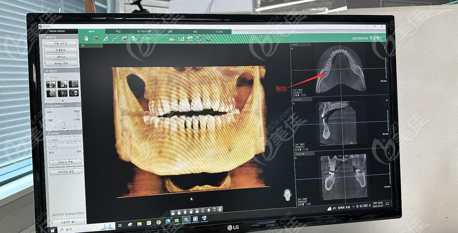 拍摄智齿CT图片
