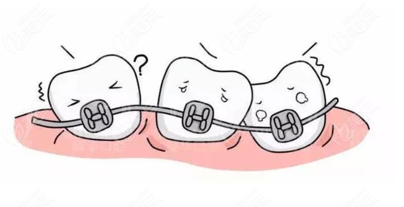 牙齿矫正过程中的移动