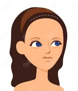 发际线高做额头缩小术价格多少