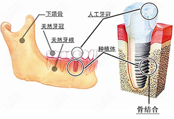 种植牙在牙骨内的图www.236z.com