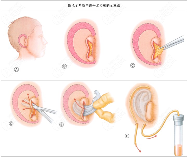 外耳再造手术过程