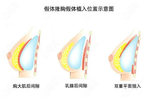 隆胸假体植入位置示意图
