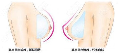 圆形隆胸假体和水滴型隆胸假体对比