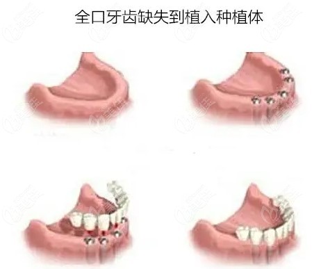 昆明全口半固定种植牙多少钱