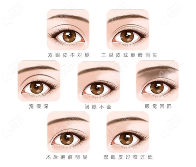 <!--<i data=20240703-sp></i>-->杜園園醫(yī)生修復(fù)雙眼皮怎么樣